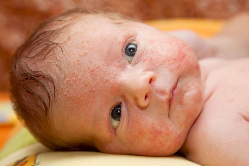 What You Need To Know About Milia And Baby Acne Frisco Pediatrician 