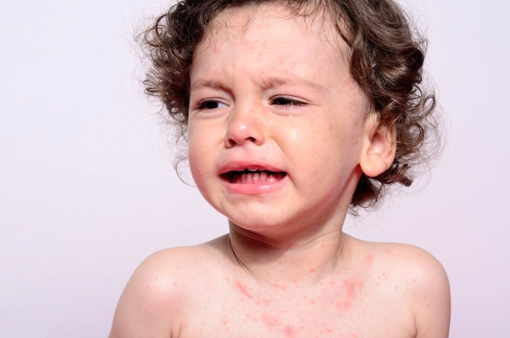 the-heat-rash-is-on-frisco-pediatrician-entirely-kids-pediatrics