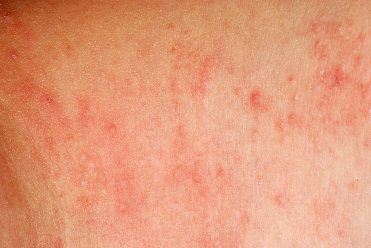 Baby Heat Rash: What to Know about Prickly Heat (Miliaria)